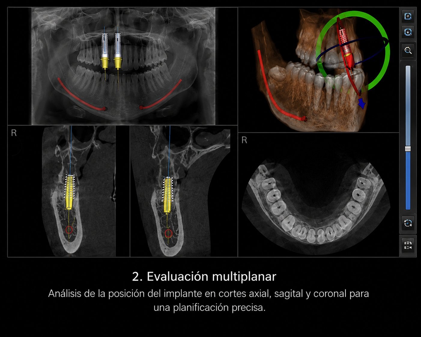 Planificación tridimensional de implantes sobre tomografía