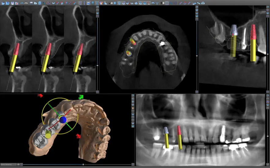 Planificación 3D real de implantes dentales sobre tomografía