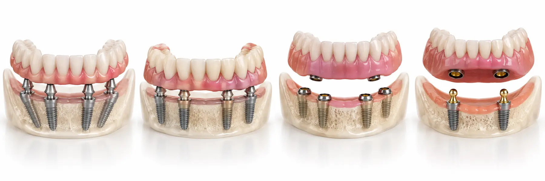 All-on-4 y prótesis híbrida fija sobre implantes